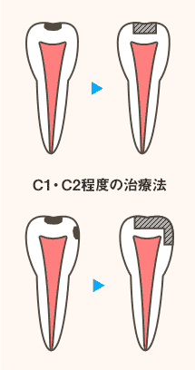 C1,C2程度の虫歯の治療法