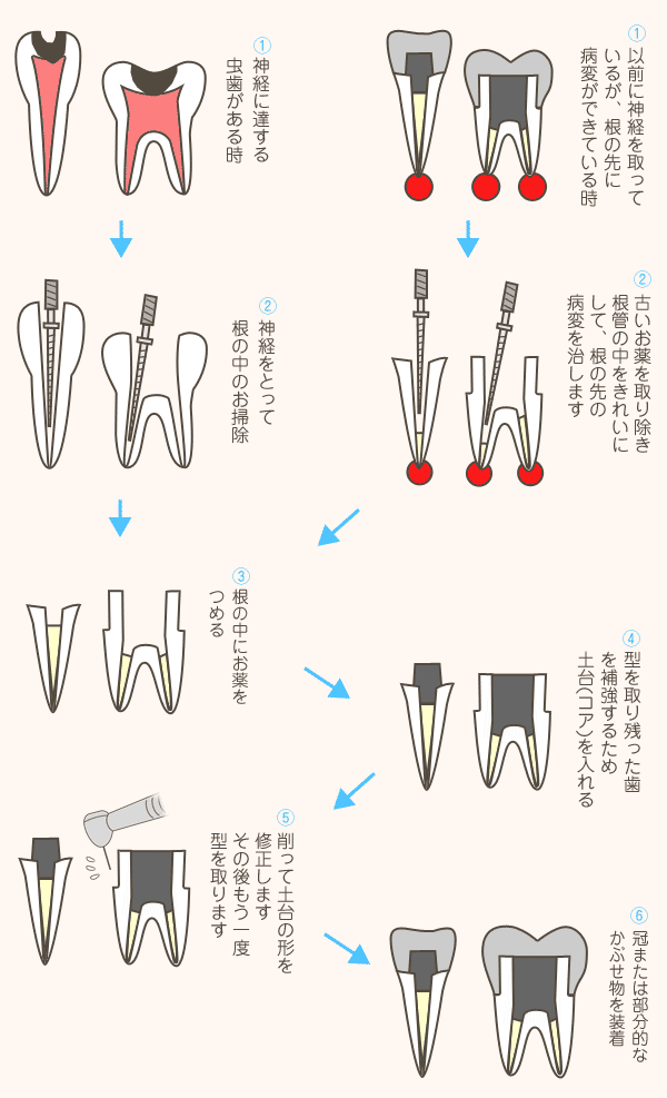 根管治療の流れ