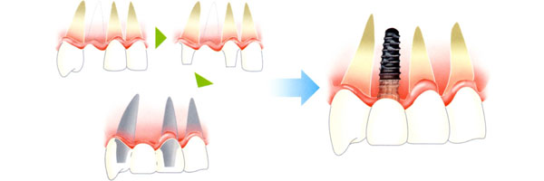 前歯のインプラント