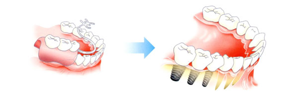 前歯のインプラント