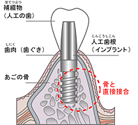 3iインプラント型取り